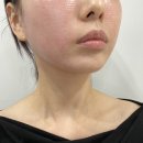 차오름동물병원 | 피부] 대구피부관리 대구플라즈마잘하는곳 아미뷰티 울쎄라보다 효과좋은 플라즈마 써마지 리프팅 후기