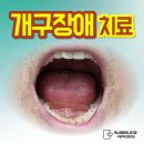 판교바른신경외과의원 | 개구장애 치료 후기, 50대 환자분의 써모스플린트 효과 〈판교 턱관절 전문치과 원장 작성〉