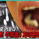 (생로병사의비밀)입안의 공포... '임플란트 주위염'/2023.12.13. 이미지