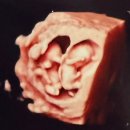 빛고을약국 | 난임병원에서 빛고을여성병원으로 전원, 임신11주차후기