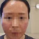 소나무약국 | 리쥬란힐러 2cc 후기 / 을지로입구역 피부과 후기