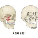 손흥민이 한 ‘안와골절 수술’이란? 이미지