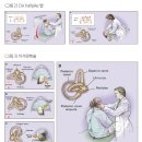 이석증 재발을 줄이는 방법 이미지