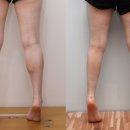 제안과의원 | [의료 칼럼] 종아리 붓기 예방을 위한 생활습관: 데이터가 제안하는 일상 솔루션 - 세이지의원