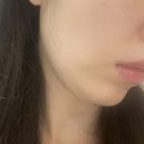 해도올 | 강남 신사역 피부과 추천 통증 없는 올타이트 리프팅 만족 후기