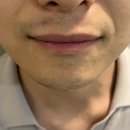 촉촉이네 | [내돈내산] 촉촉이 아빠의 부산 남자 레이저제모 솔직후기(광고x)