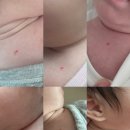 오라클 안경 | 신생아 혈관종 진료 후기 | 레이저, 약물치료, 오라클피부과 인천송도점