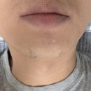 모리스 | [내돈내산 후기] 남자 수염 제모 5회차 후기 (모리스 의원)