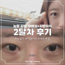 용의주도 | 눈밑지방 재배치 + 지방이식 솔직후기 :: 2달차 후기!