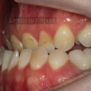 정치과의원 | 성장기 교정후 재발한 주걱턱, 양악수술 교정 과정 후기. 반대교합 셀프 확인법. 잠실 교정치과