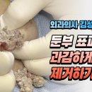 [어떤분들에겐 혐오주의] 둔부 피지낭종 표피낭종 과감하게 제거하기 이미지