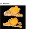 Adrenal adenoma 이미지