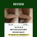 잠실팔뚝사후관리ㅣ팔뚝지흡 후 무거운 팔 탈출! 단 1회 만에 가벼워진 팔뚝 라인😍