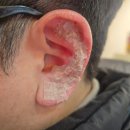 이혈(귀) 상담과 건강관리 | 순환｜스트레스로 무거웠던 몸, 남자도 부담 없이 받는 이혈테라피로 두통·불면·어깨 통증까지 가볍게...