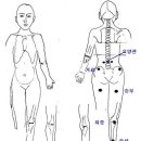 [벌침] 허리디스크 이미지