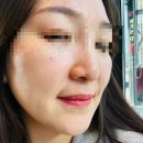 대구 반월당 피부과 쥬베룩 스킨부스터 내돈내산 효과자랑 후기