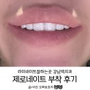 이코어치과기공소 | 강남 치과추천 치아 라미네이트잘하는곳에서 제로네이트 부착한 리얼후기