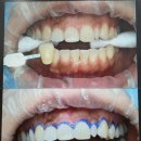 대학치과의원 | 강동 치아미백 치과 여신티켓 후기 대학치과의원 천호 내돈내산