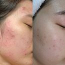 에르케어광영지사 | [공구 OPEN] 볼라욘 이노브겔 7년 사용해 본 사람이 직접 알려주는 사용 꿀팁과 피부 좋아지는 법