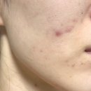 화농성, 응괴성, 좁쌀 트러블 박살낸 여드름화장품 뾰루나세럼(전후사진有)