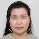 올케어성형외과의원 | 2025년 한 해, 가장 많이 한 수술은? (수원성형외과)