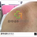 오른쪽어깨통증 통풍 원인이라고? 이미지