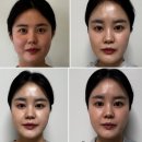 3456 | 한티역피부과 티베룩 티타늄리프팅 쥬베룩볼륨 팔자주름 후기