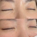 수정-69 | 수원아이라인 망했을때? 리커렉션 수정복원 실제후기