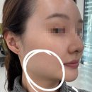 (주)수원제일공업사 | 수원 광교 키닥터피부과 처진 얼굴 고민끝 올타이트리프팅 400샷 내돈내산 후기