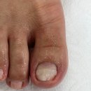 레푸스인하대역점 내성발톱 무좀발톱 발각질 문제성발 이미지