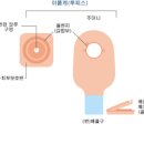 인공항문, 장루 주머니 (간호, 교환방법) 이미지