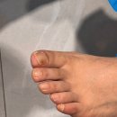 레푸스 평촌점 | 레푸스 안양 평촌점 발톱 스케일링 관리 후기