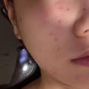 분당 편평사마귀 성지 한의원 후기 듀오덤X 얼굴 목 무제한 제거