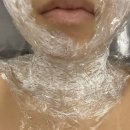 카리스의원 | [내돈내산] 유온느의원 편평사마귀 점제거 후기