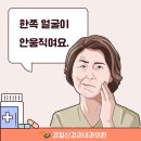 [대구경일신경과내과의원] 안면마비 벨마비 구안와사 한쪽얼굴이 안움직여요.