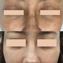 민정보시스템 | 졸로픽스 민타비20 민타비 논크림 사용 효과 후기 제품 및 할인 정보