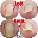 풋사랑 정형외과 의원 | 부산 내성발톱