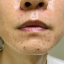 테크로밸리1로1L | 모낭염 성지글 유산균4종 3개월 후기 피부상태 공개 (소금물,기버터)