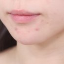 시행착오 | 입주변 여드름, 턱밑 뾰루지 원인부터 관리 루틴까지 (5년 시행착오 후기)