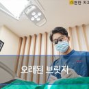뚝섬힐링치과의원 | 뚝섬역치과 오래된 브릿지로 인한 잇몸 염증 임플란트로 해결!