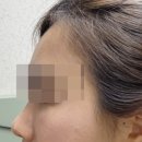선릉역 피부과 눈밑 다크서클필러 솔직 후기