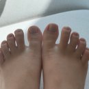 레푸스원주점 | 원주 내성발톱 '레푸스 원주점' 관리 비포 & 애프터 후기 | 발톱 무좀 케어부터 맞춤 인솔 제작까지...