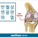 무릎연골수술//반월상연골판파열 관절내시경으로 치료하자//관절내시경수술잘하는곳 이미지