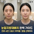 에버성형외과 | 눈밑지방재배치 완벽 가이드, 효과·부작용·수술 전후·병원 선택까지