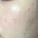 아크리스 | 여드름피부 클렌징폼 추천: 아토뮤 아크리스 약알칼리성클렌징폼 사용 후기