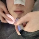 명동 리쥬란힐러 추천 일주일 효과 내돈내산 후기