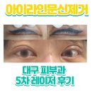 라인5차 | 아이라인문신제거_5차] 반영구아이라인문신제거 5차 내돈내산후기 숙원사업 (대구피부과후기) 이제 다...