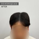 레이븐스칼프