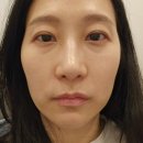 닥터이레이저피부과의원 | 강남피부과 닥터이레이저 피부과 5살 어려지는 쥬베룩볼륨 후기