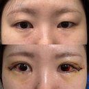 평안약국 | [쌍수 재수술] 누운 김에 뒷밑트임까지 수술 당일~7일차 후기